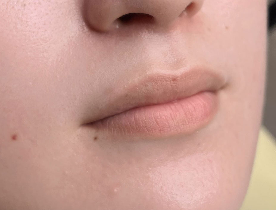 飯田橋IB歯科のリップアートメイク|施術前|Before|CASE01