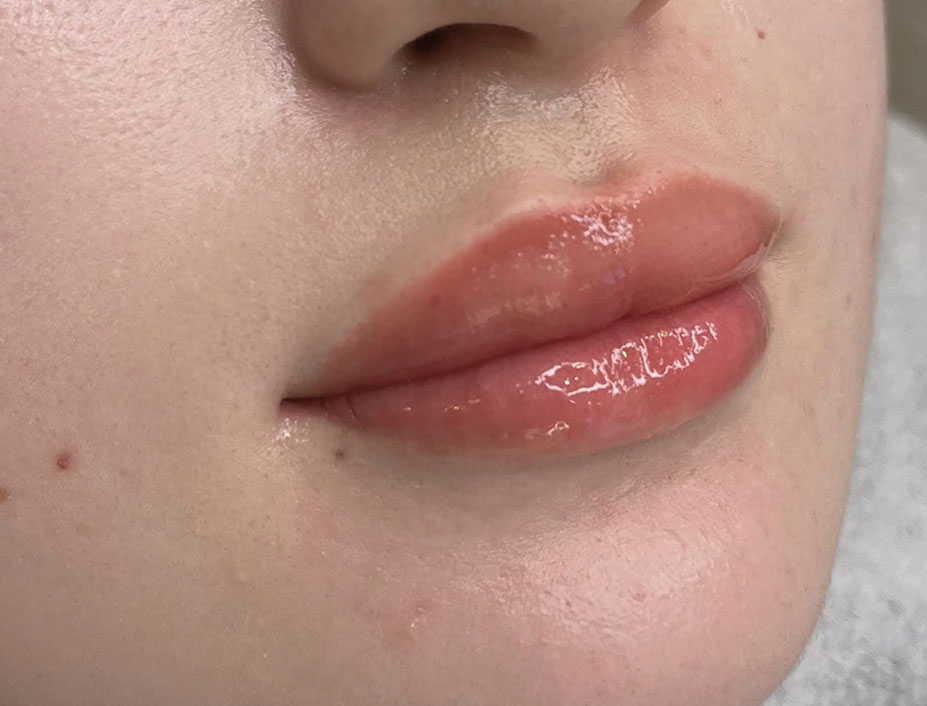 飯田橋IB歯科のリップアートメイク｜施術後｜After｜CASE01