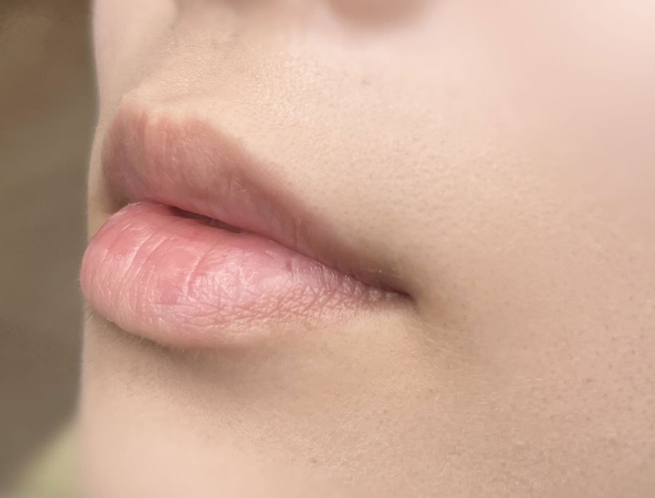 飯田橋IB歯科のリップアートメイク|施術前|Before|CASE02