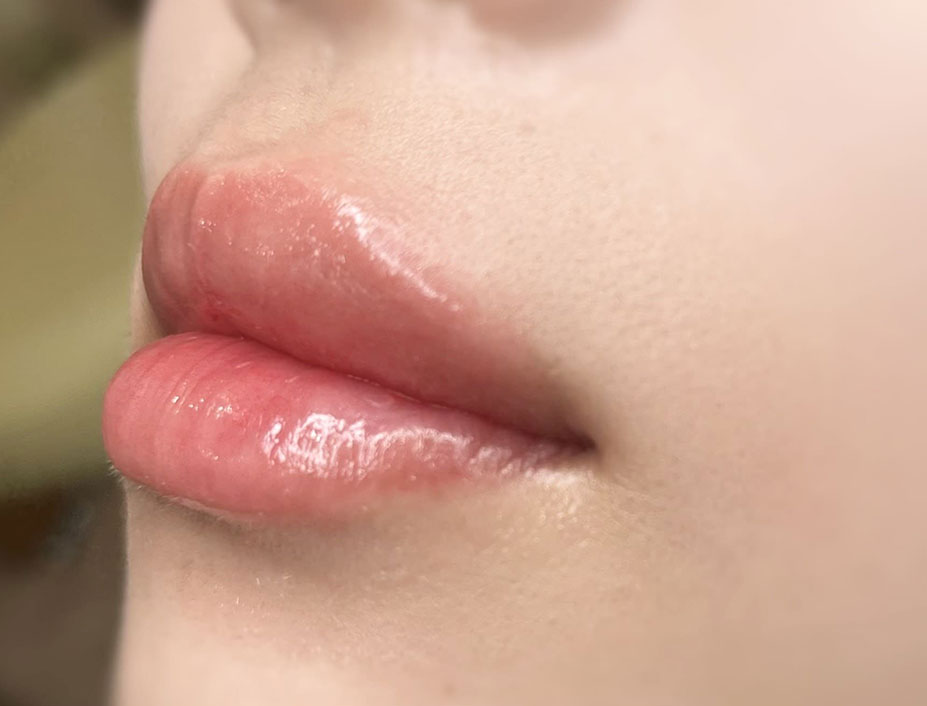 飯田橋IB歯科のリップアートメイク｜施術後｜After｜CASE02