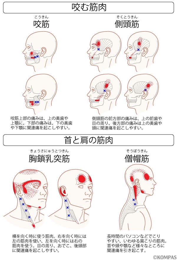 歯ぎしり食いしばりと関係のある筋肉 咬筋 飯田橋IB歯科の歯ぎしり食いしばり治療|飯田橋駅徒歩2分