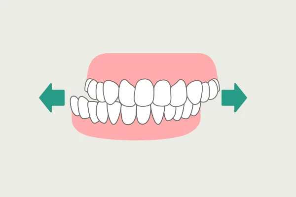 歯ぎしり グラインディング 症状 歯ぎしりの種類 飯田橋IB歯科 飯田橋駅徒歩1分