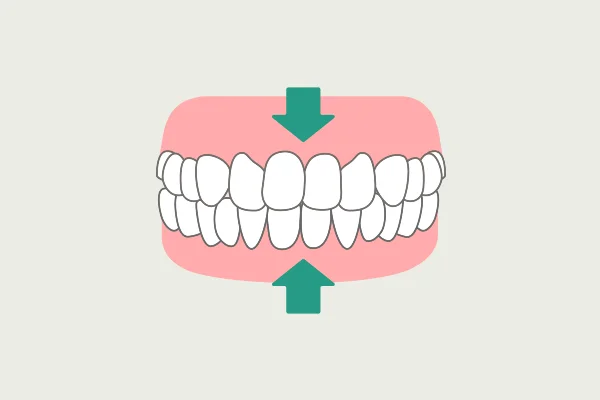 食いしばり クレンチング 症状 歯ぎしりの種類 飯田橋IB歯科 飯田橋駅徒歩1分