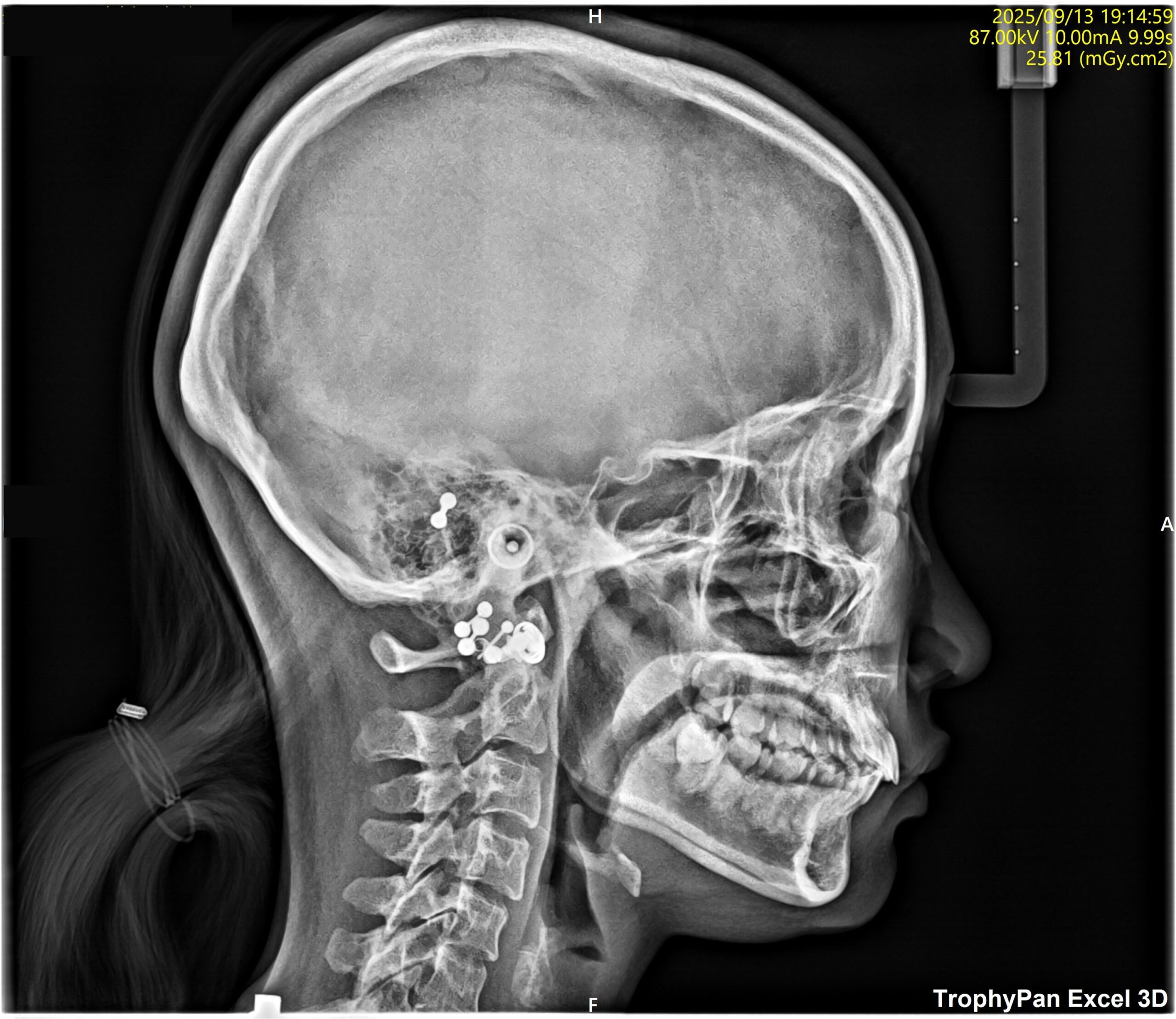 飯田橋IB歯科のバイタルリアクトセラピー 施術後 After 歯科 整体
