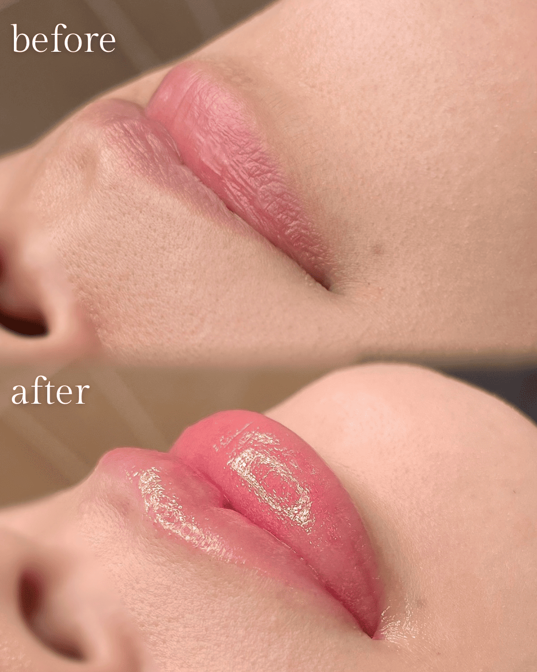 飯田橋IB歯科のリップアートメイク|施術前・施術後|Before After|CASE01