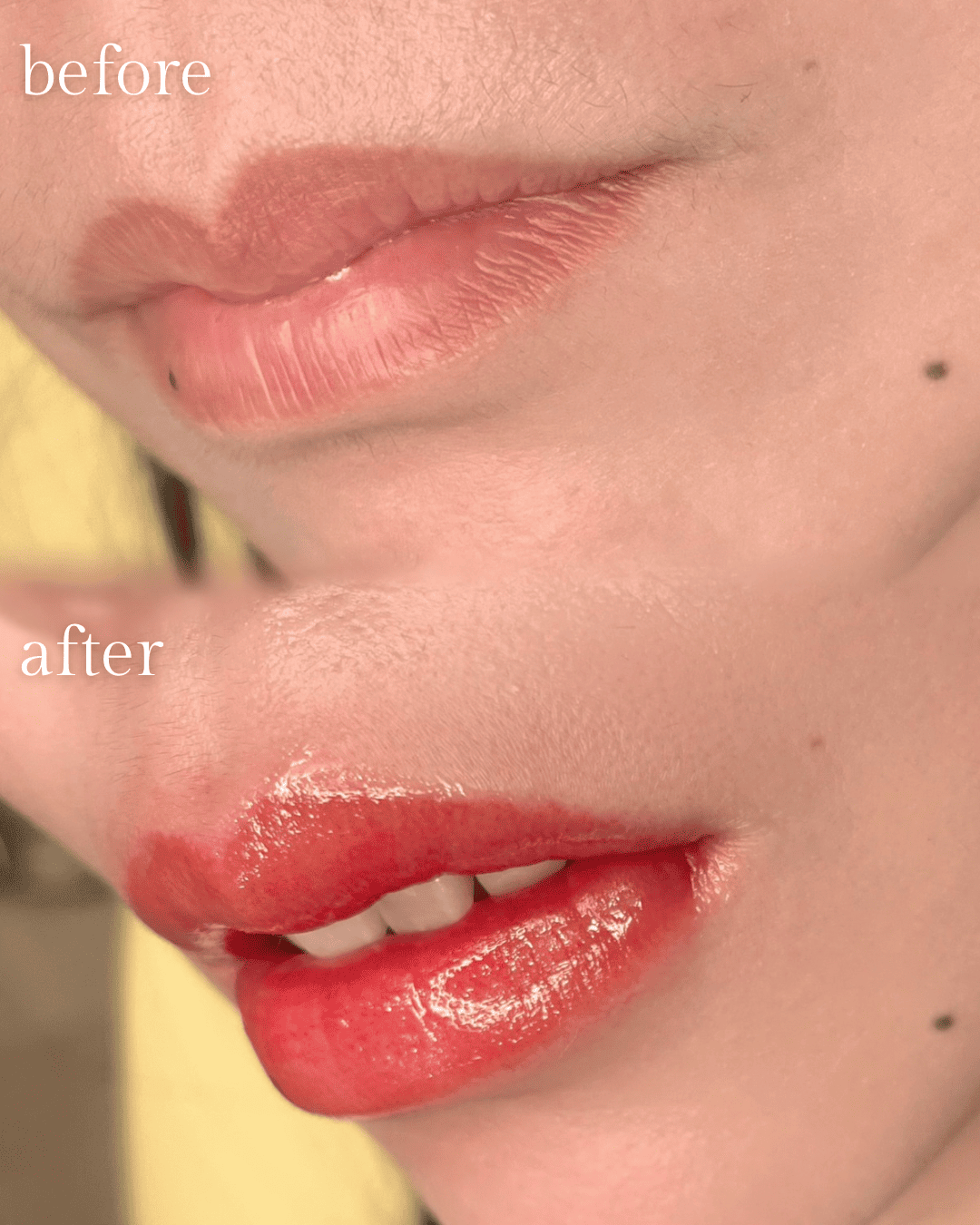 飯田橋IB歯科のリップアートメイク|施術前・施術後|Before After|CASE02