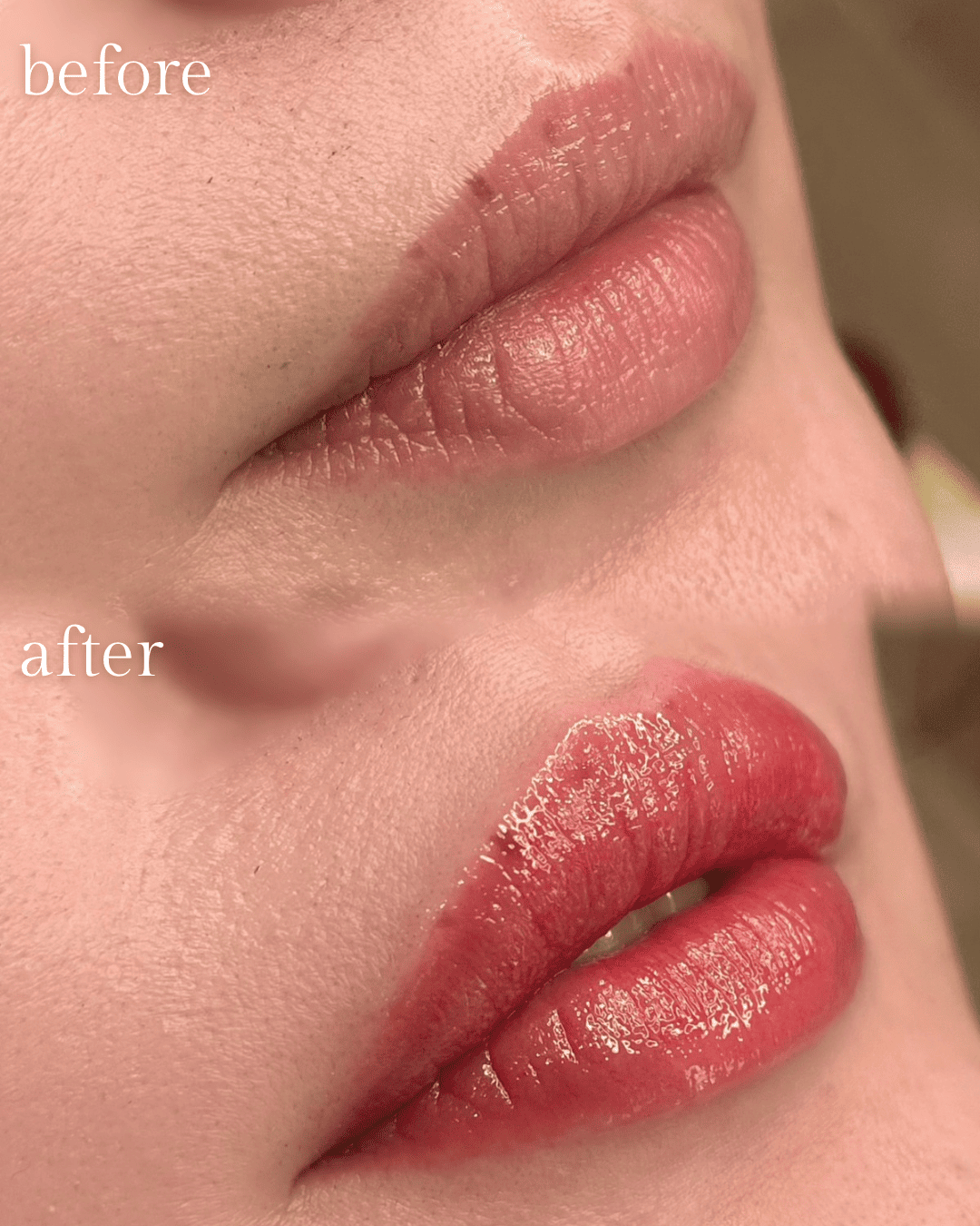 飯田橋IB歯科のリップアートメイク|施術前・施術後|Before After|CASE03