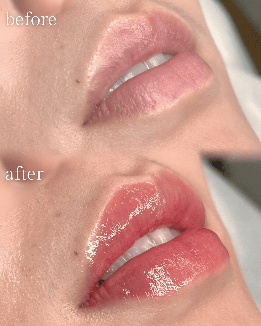 飯田橋IB歯科のリップアートメイク|施術前・施術後|Before After|CASE04